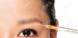 玻尿酸豐眉弓示意圖