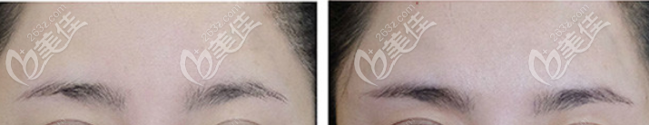 玻尿酸豐眉弓案例效果圖