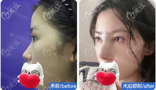 榫卯隆鼻術(shù)前術(shù)后即刻對(duì)比圖 榫卯隆鼻術(shù)前術(shù)后即刻對(duì)比圖