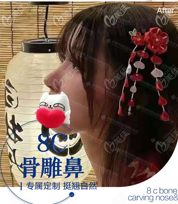 我就是看重他家肋軟骨鼻綜合鼻頭支架的搭建方式—榫卯結(jié)構(gòu),才做的鼻子