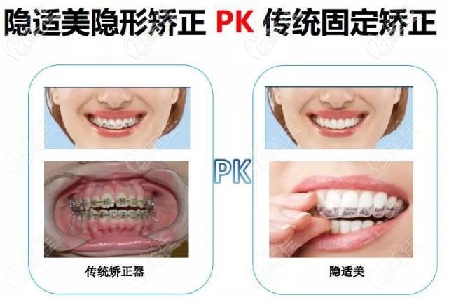 隱適美可以矯正30歲的齙牙問題 隱適美可以矯正30歲的齙牙問題