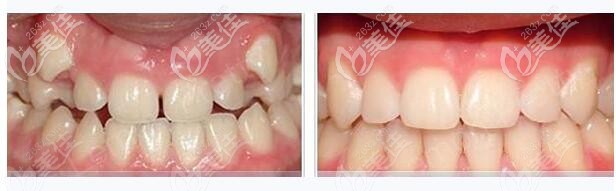 30歲齙牙矯正前后對比：這一次在無錫維樂口腔沒用鋼牙套，做的是隱適美正畸