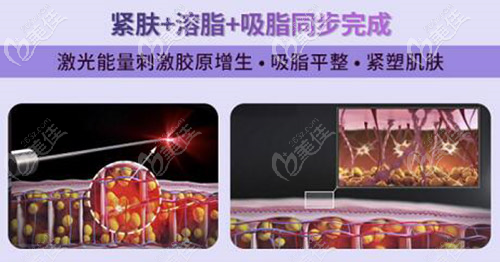 5g天使光雕集緊膚+溶脂+吸脂同步進(jìn)行 5g天使光雕集緊膚+溶脂+吸脂同步進(jìn)行
