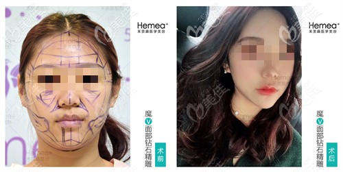 任學(xué)會(huì)全臉自體脂肪填充