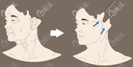 小切口拉皮位置 小切口拉皮位置