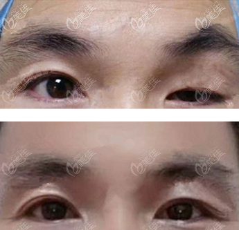 CFS上瞼下垂手術(shù)效果圖 CFS上瞼下垂手術(shù)效果圖