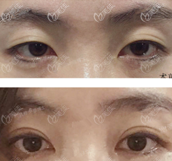上瞼下垂提肌折疊效果圖 上瞼下垂提肌折疊效果圖