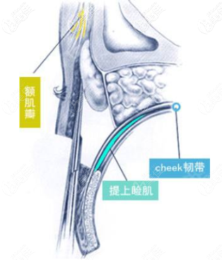 CFS手術(shù)操作圖示 CFS手術(shù)操作圖示