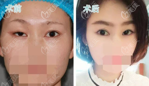 cfs上瞼提肌北京誰(shuí)做得好 cfs上瞼提肌北京誰(shuí)做得好