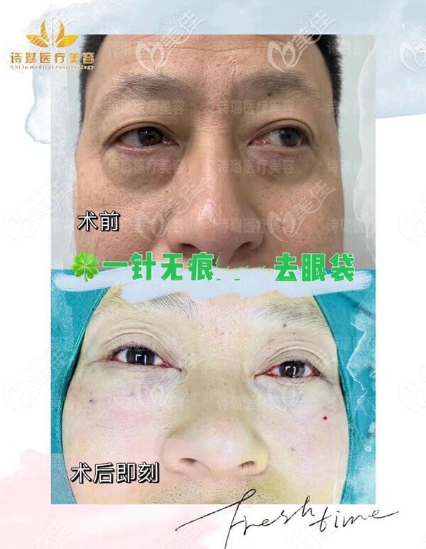 詩璐一針無痕祛眼袋案例 詩璐一針無痕祛眼袋案例