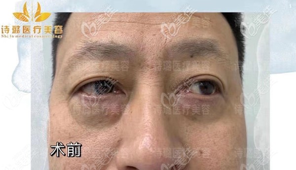 詩璐祛眼袋術(shù)前圖 詩璐祛眼袋術(shù)前圖