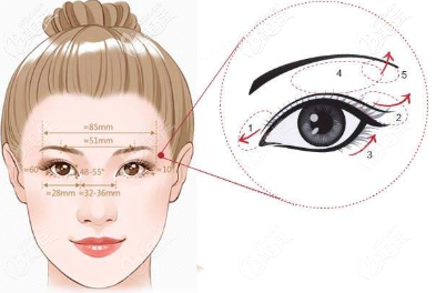 無內眥贅皮的雙眼皮標準