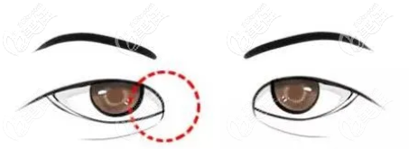 內眥贅皮示意圖