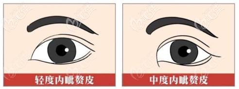 內眥贅皮不同分型示意圖