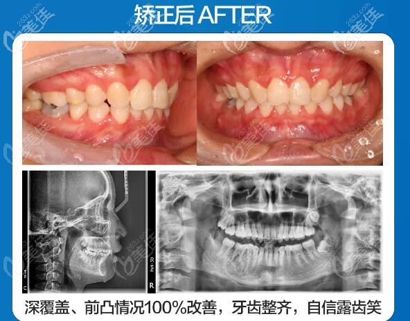 這是我在合肥貝杰口腔臨泉路店矯正牙齒的日記:深覆蓋+骨性前突哦