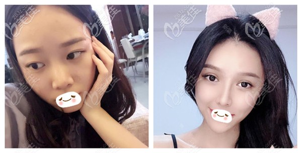 錢炳燊醫(yī)生做軟骨鼻綜合案例