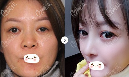 凌斌醫(yī)生做半肋鼻綜合案例