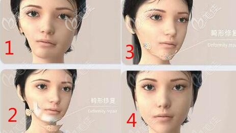 3d打印人工骨修復(fù)下頜角手術(shù)示意圖 3d打印人工骨修復(fù)下頜角手術(shù)示意圖