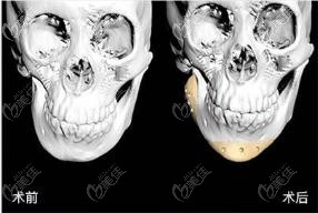 3d打印人工骨修復(fù)下頜角術(shù)前術(shù)后ct片對比 3d打印人工骨修復(fù)下頜角術(shù)前術(shù)后ct片對比