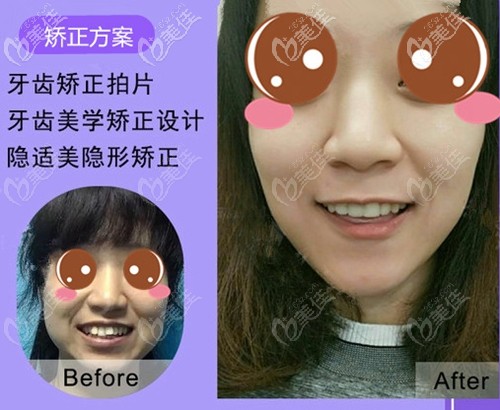 天生牙齒不齊30歲才在廈門峰煜口腔做了隱適美隱形矯正，沒想到效果不錯