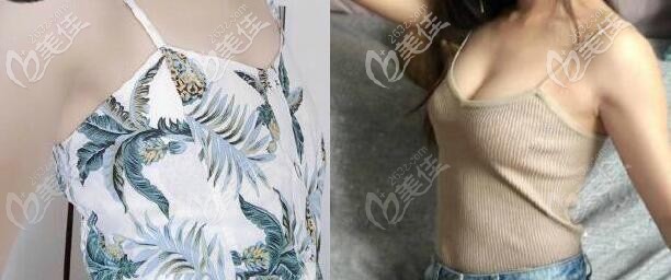 曼托水滴250cc假體隆胸一年效果圖片