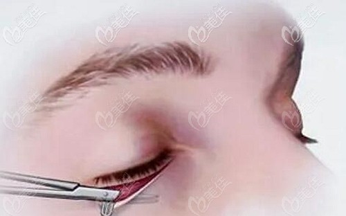 外眥懸吊手術(shù)的原理