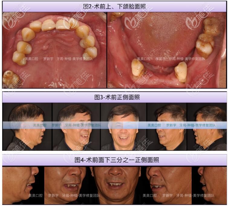 牙齒松動脫落術前樣子 牙齒松動脫落術前樣子