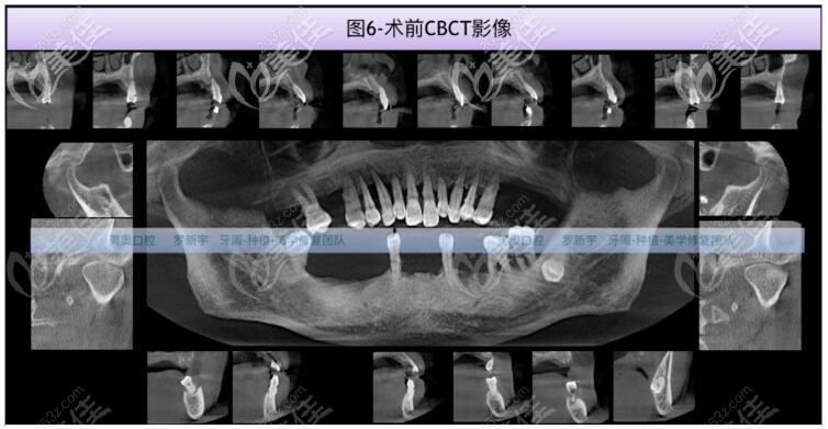 CT拍片檢查牙齒情況 CT拍片檢查牙齒情況