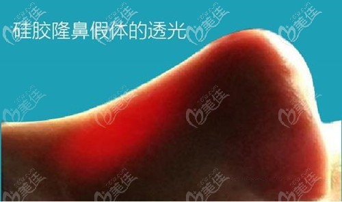 用自體筋膜可防止假體透光