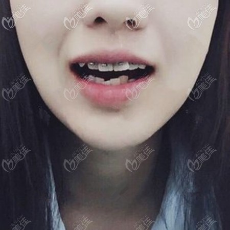 剛戴金屬自鎖牙套會感覺不太適應 剛戴金屬自鎖牙套會感覺不太適應