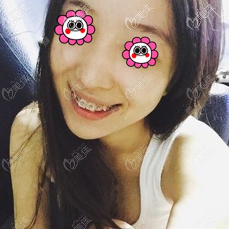 牙齒在矯正中不斷產(chǎn)生變化 牙齒在矯正中不斷產(chǎn)生變化