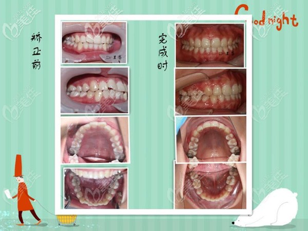 在宣城宛陵口腔做牙齒矯正的圖