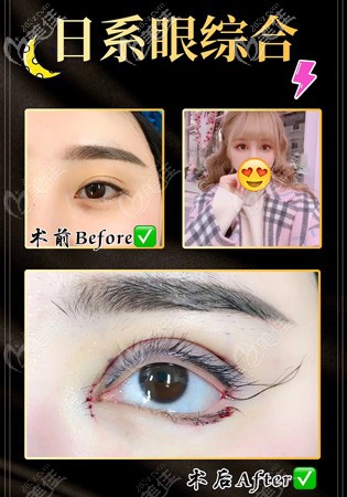 顧客到銅陵晶美做眼綜合術(shù)前術(shù)后對(duì)比 顧客到銅陵晶美做眼綜合術(shù)前術(shù)后對(duì)比