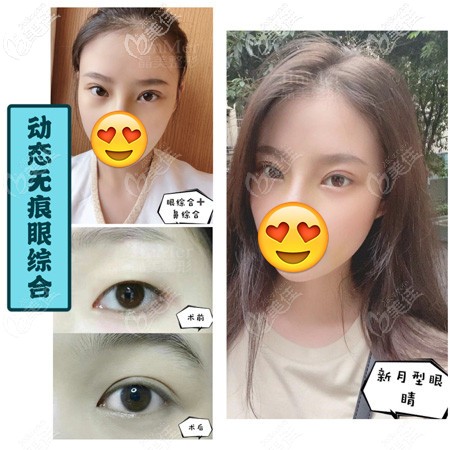 雙眼皮改型到銅陵晶美做的效果 雙眼皮改型到銅陵晶美做的效果