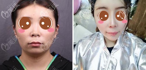 葉麗萍博士海鷗線隆鼻案例