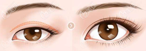 章沈云雙眼皮特點