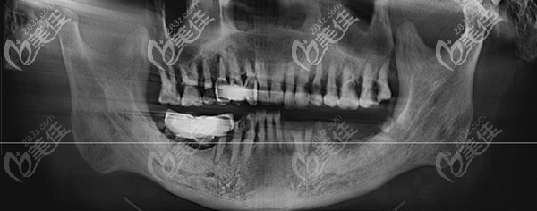 術(shù)前下半口無牙