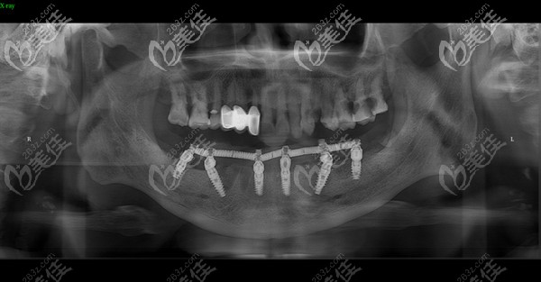 石家莊趙翠彩口腔做下頜all-on-6術(shù)后恢復(fù)正常