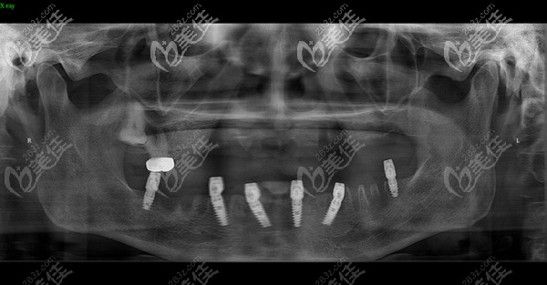 石家莊趙翠彩口腔做下頜all-on-6后恢復(fù)情況