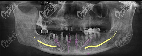 術(shù)前下頜牙齒缺失