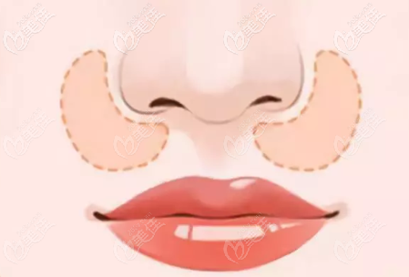 鼻基底凹陷示意圖