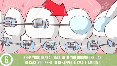 正畸保護蠟使用方法