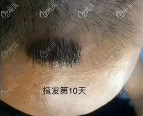 西安沐森植發(fā)密度60的<span style= 西安沐森植發(fā)密度60的<span style=