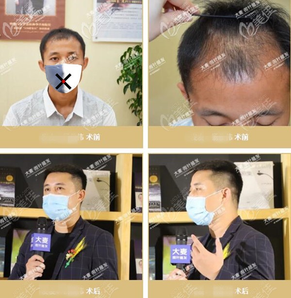 植發(fā)十年后會變成怎樣?這份微針植發(fā)10年以上案例效果回給你答案