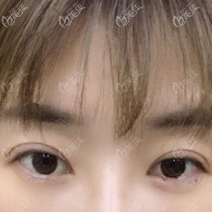 彭繼忠為我做內(nèi)切祛眼袋術后三天效果