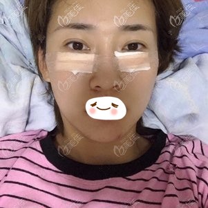 在<!--<i data=20240703-sp></i>-->剛割完眼袋后的樣子