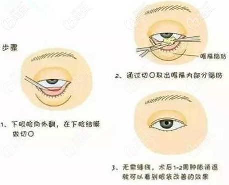 彭繼忠做微創(chuàng)祛眼袋手術