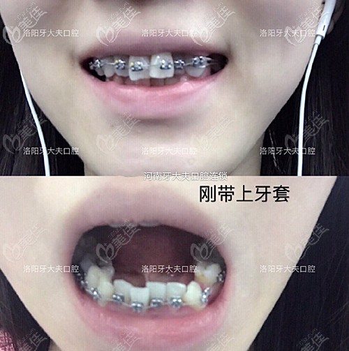 剛帶上牙套的效果