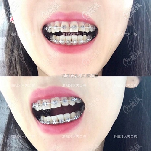 牙齒矯正半年效果