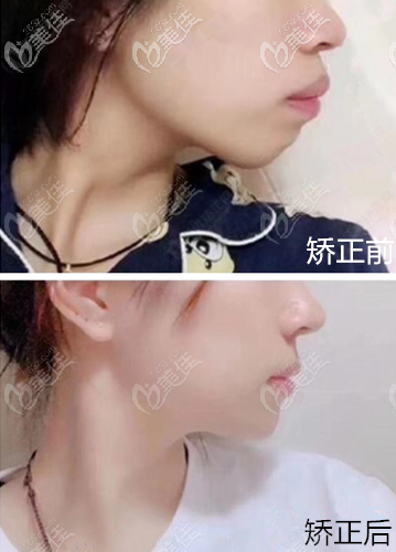 重慶團圓口腔骨性齙牙牙齒內收4mm側顏效果圖 重慶團圓口腔骨性齙牙牙齒內收4mm側顏效果圖